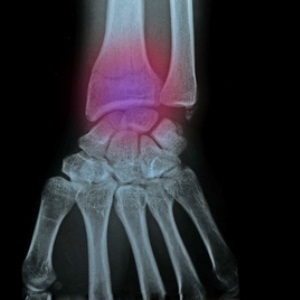 Wrist fracture from Shutterstock