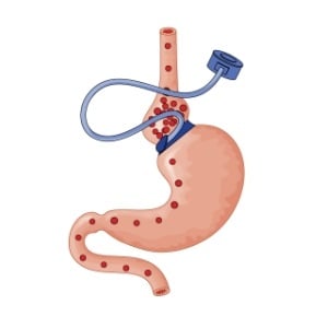 Gastric band from Shutterstock