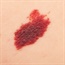 Why does death risk from melanoma rise after loss of spouse or partner?