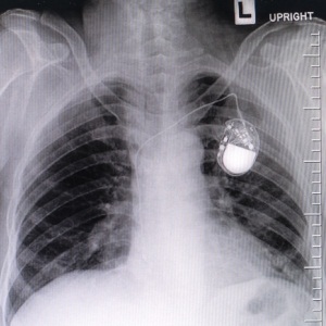 Chest with pacemaker from Shutterstock