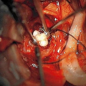 Doctors remove teeth from a tumour. Credit: New England Journal of Medicine