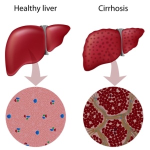 Liver cirrhosis cured in rats | Life