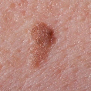 Liver spots should be checked for cancer | Health24