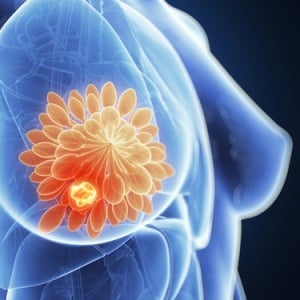 Breast cancer from Shutterstock
