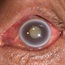 High blood pressure may boost glaucoma risk