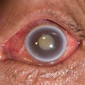 Acute angle closure glaucoma of the eye during an eye examination.