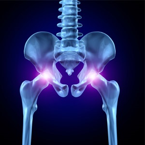 Exercise may help severe osteoarthritis