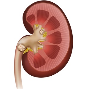 Kidney stones from Shutterstock