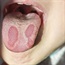 Could you have a geographic tongue?