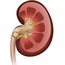 Kidney stones linked to weaker bones