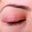 Cystic eyelids-palmoplantar keratosis-hypodontia-hypotrichosis