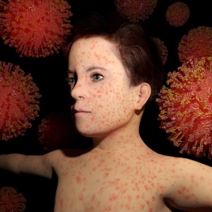 Child with measles from Shtterstock