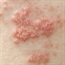 Approximately 90% of adults are at risk for shingles