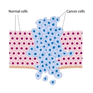 Cancer cells from Shutterstock