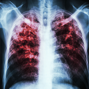 "Pulmonary tuberculosis" Film chest x-ray show interstitial infiltration both lung due to mycobacterium tuberculosis infection
