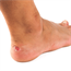 Chafing, athlete's foot, blisters, acne - skin problems runners have to deal with