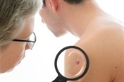 Diagnosing skin cancer