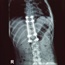 Spinal stimulation system relieves back pain without 'tingling'