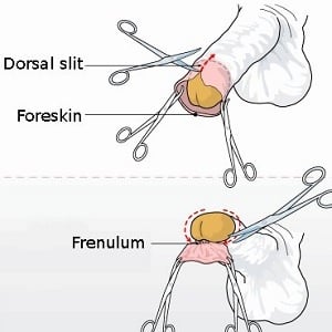 oral circumcised technique Different uncircumcised sex