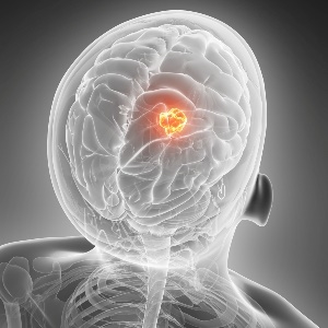 The survival rate for glioblastoma is low. 