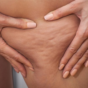 Cellulite is caused by fibrous bands.