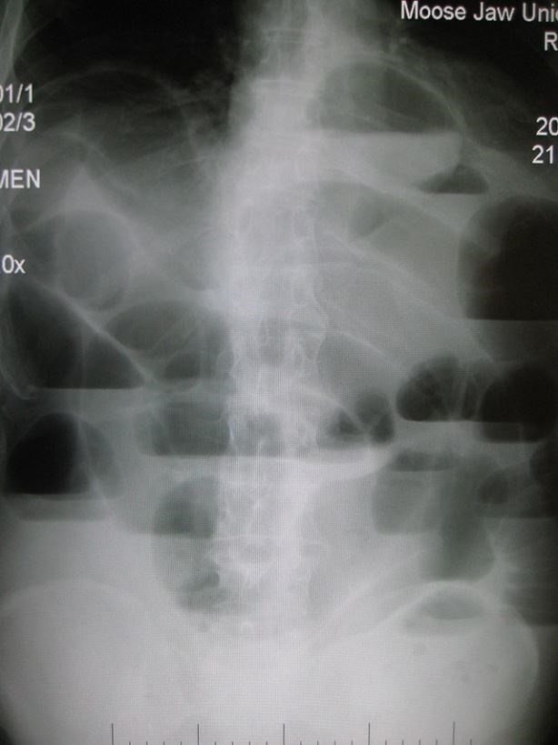 abdominal x-ray showing pathology