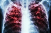 What causes tuberculosis?