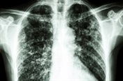 Symptoms of tuberculosis