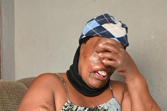 47-year-old Dipuo Kokolosi is trying to regain her confidence after she was mauled allegedly by her bosses three pit bulls. Photo by Morapedi Mashashe