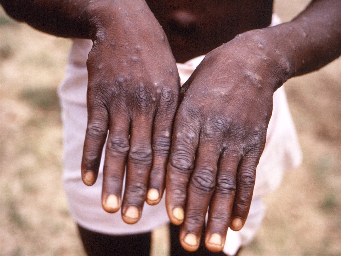 rare-monkeypox-outbreaks-detected-in-north-america-europe-news24