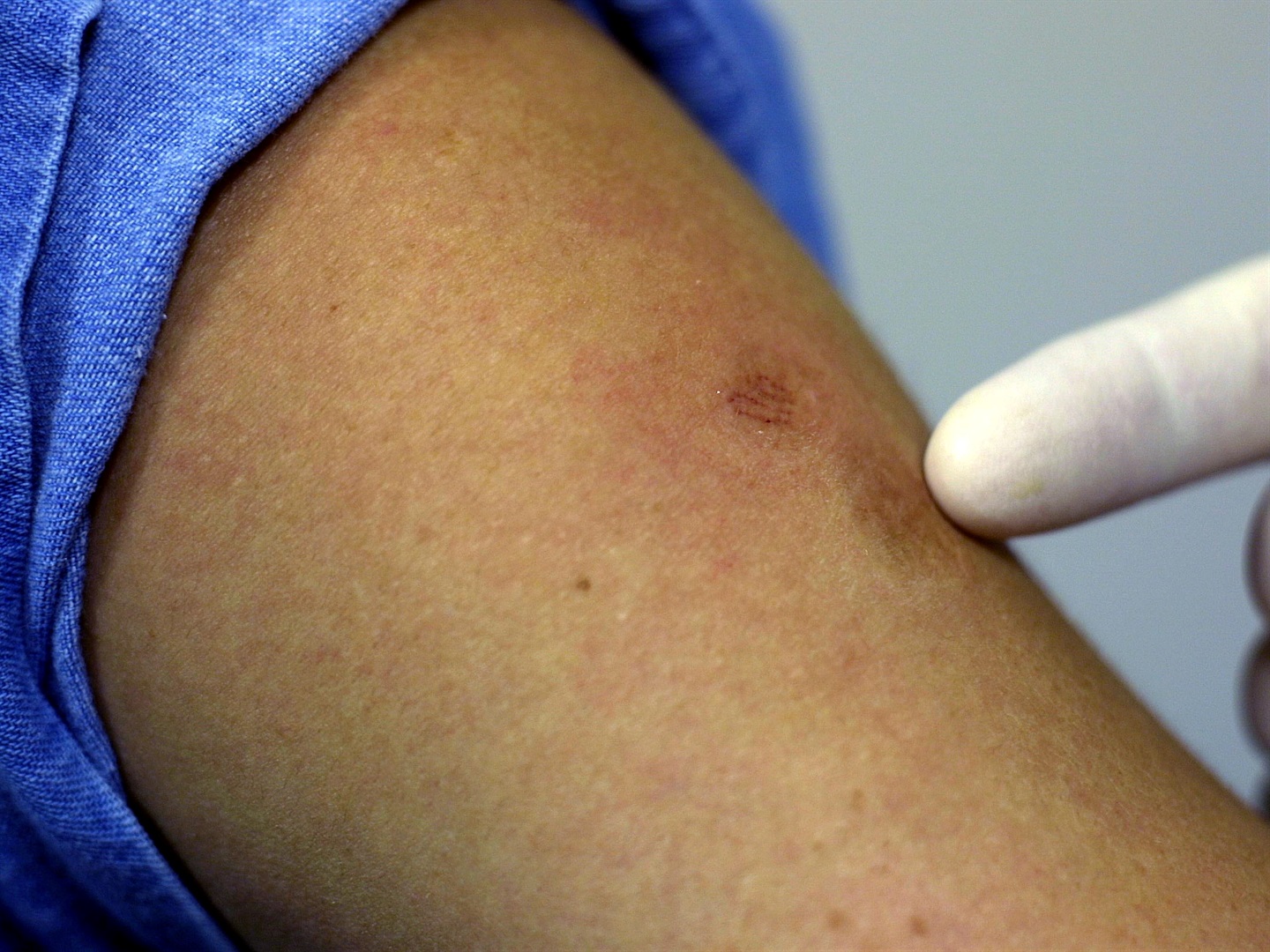 A doctor points to a patient's scars from a smallpox vaccination on December 16, 2002 in Florida. Chris Livingston/Getty Images