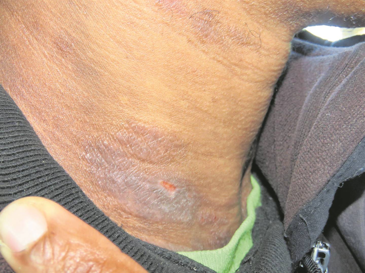 A pastor from Katlehong in Ekurhuleni was left with scars on his neck after he was kidnapped and tortured by thugs on 1 July.                          Photo by Ntebatse Masipa