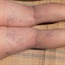 Learn more about varicose veins