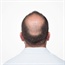 9 factors that affect male hair loss