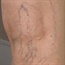 Test how much you know about varicose veins
