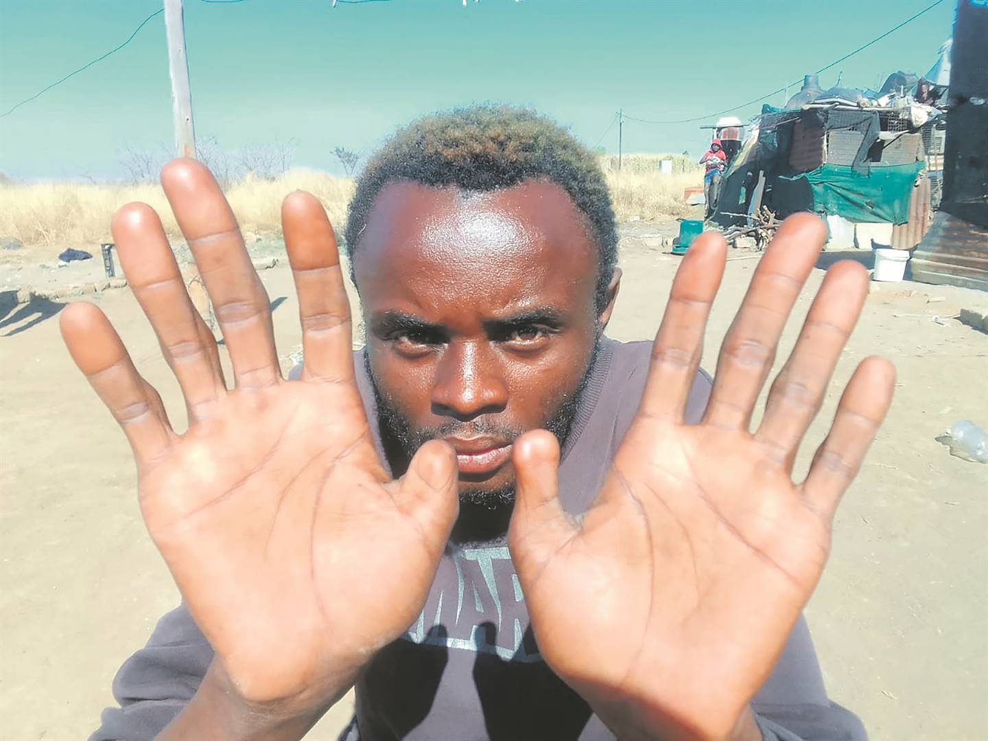 TRAUMA:   Tshepo Lebudi said he wants his thumbs back.               Photo by     Raymond Morare