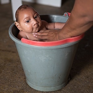 A Brazilian baby with microcephaly. (Felipe Dana, AP) 