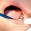 Everything you need to know about tooth implants