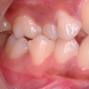 Crooked teeth - Google Free Images