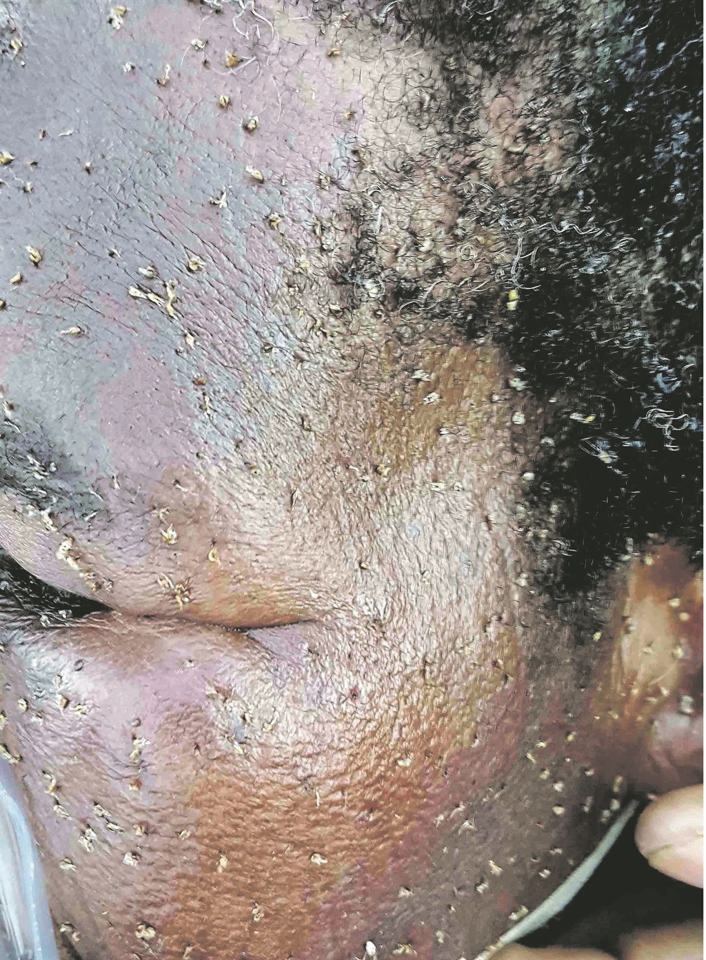This woman was stung as her grandchildren threw stones at the bees.  Photo by Netcare 911 
