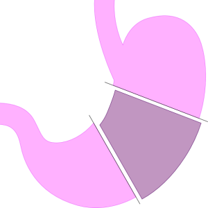Sleeve gastrectomy– Google Free Images