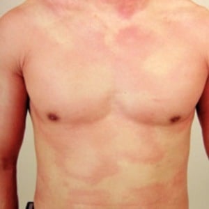 There's a new drug to treat chronic hives. 