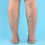 Varicose veins? Don't do these exercises