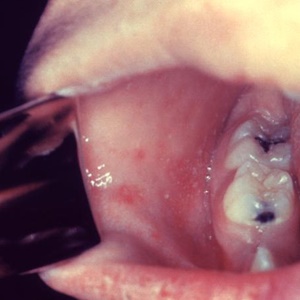 Koplik spots in the mouth are one of the earliest symptoms of a measles infection.