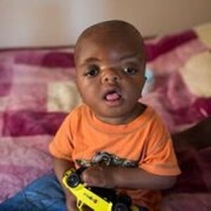 Ashbrite, a baby with apert syndrome