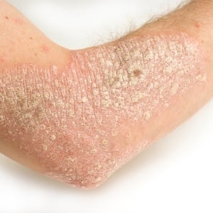 Eczema can lead to suicidal ideation.