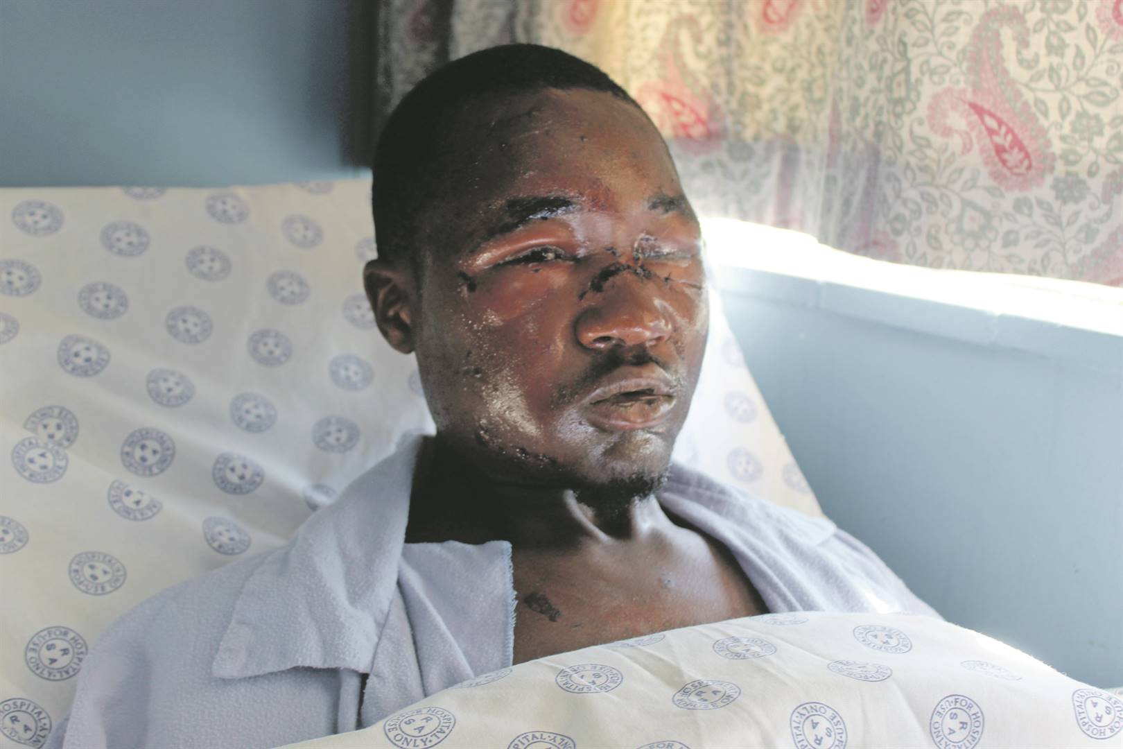BRAVE MAN:Ndumiso Mona said he kept on struggling while calling for help during the leopard attack.           Photo by Bulelwa Ginindza