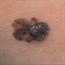 Study questions link between multiple moles and melanoma risk