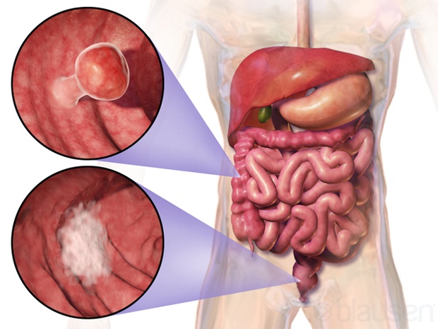 colorectal cancer illustration