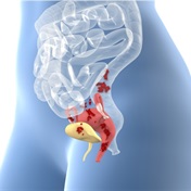 EXPLAINER | What is endometriosis?